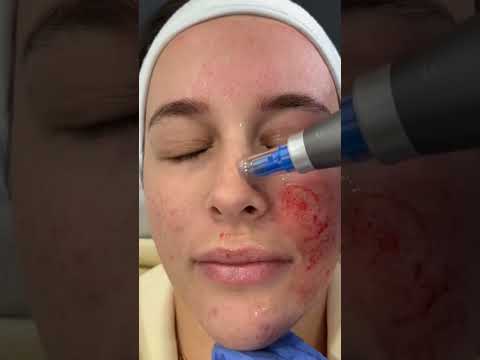 ديرما بن الأصلية بتتعرف ازاى