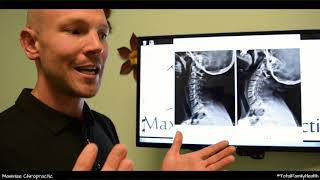 Corrective Chiropractic Care Explained - Sacramento Chiropractor