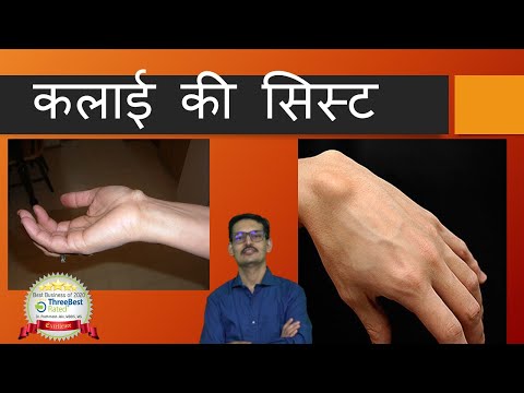 कलाई-की-सिस्ट Wrist Ganglion Cyst Hindi.