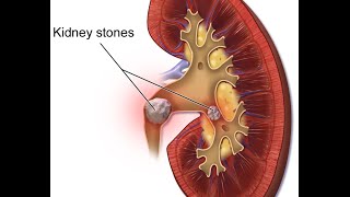 Nephrolithiasis