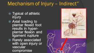 EBP video - Lisfranc Injuries (Summer 2012)