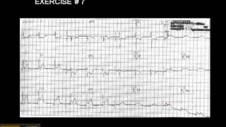 12-15 Lead ECG:  Exercise # 7