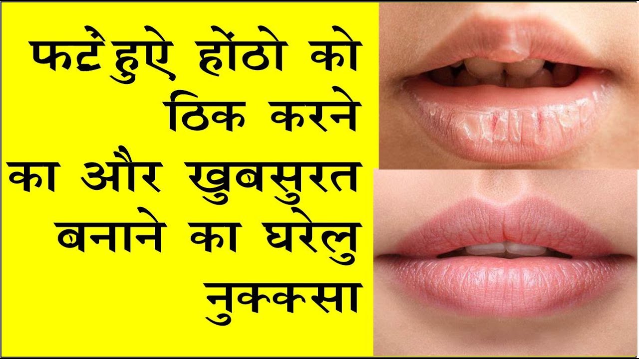 Fate Hue Lips Ko Theek Krne Ka 3 Ghrelu nuksshe (Hindi me) YouTube