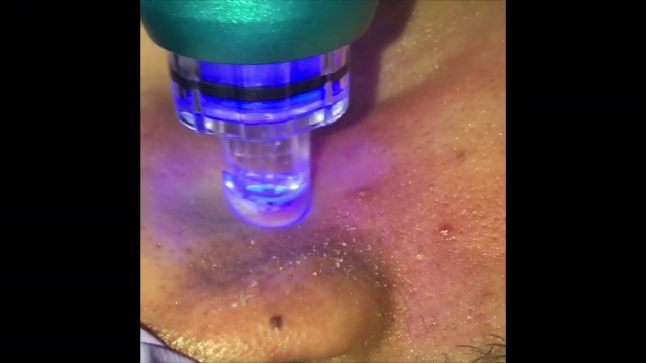 Sneak Preview of New H2O Facial