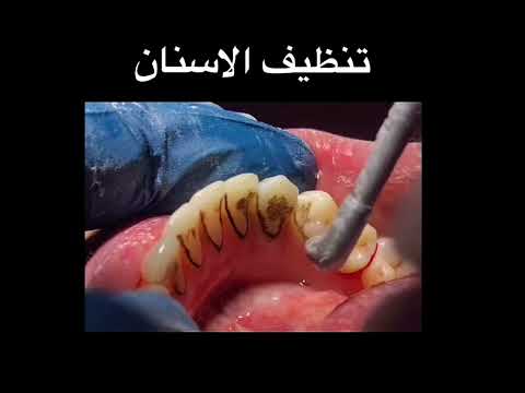 تنظيف جير الاسنان