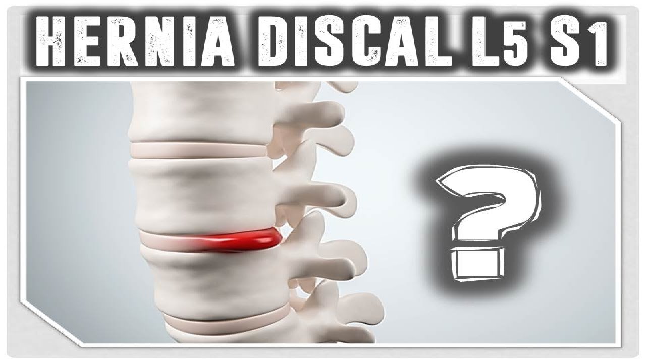 CÓMO CURAR UNA HERNIA DISCAL L5S1 DE MANERA DEFINITIVA! HERNIA DISCAL