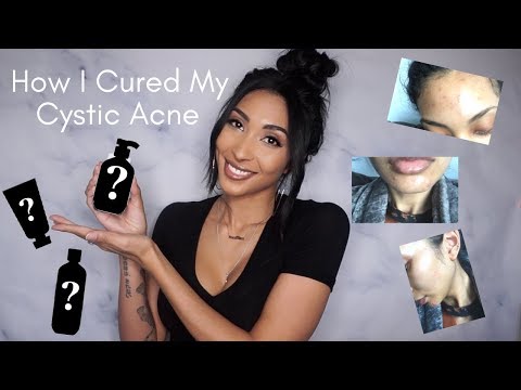 HOW I CURED MY CYSTIC ACNE IN  WEEK + My Current GO-TO Acne Products
