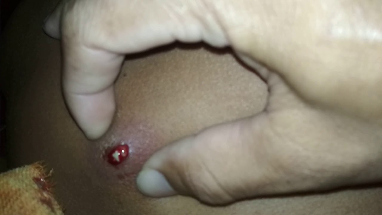 Bisul Punggung Youtube