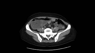 Colon adenocarcinoma