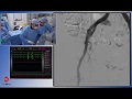 Transcatheter Aortic Valve Implantation (TAVI)