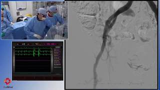 Transcatheter Aortic Valve Implantation (TAVI)