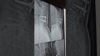 Best Neurosurgeon in Punjab | Percutaneous Endofusion (OLLIF) | Spine Masters