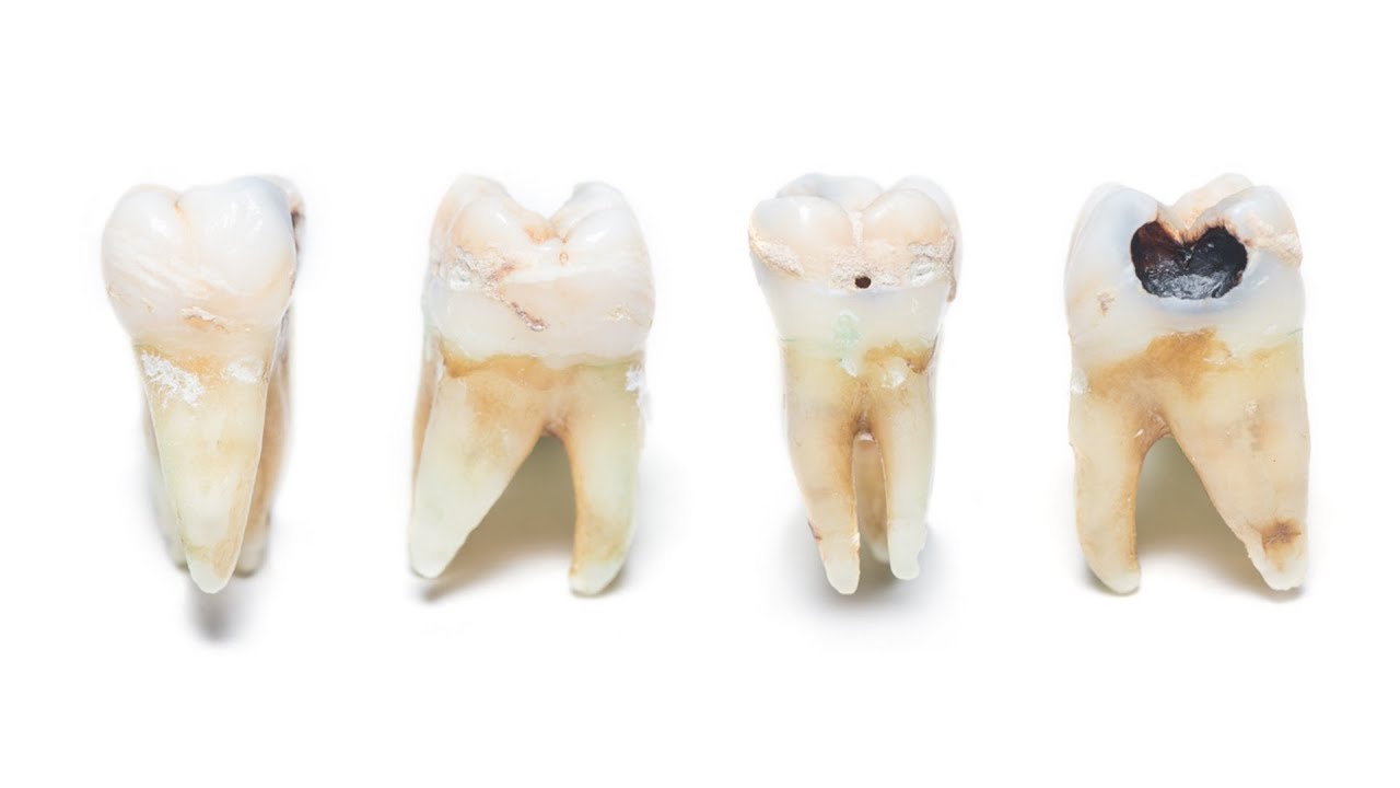 Как выглядит кариес: фото зубов, пришеечный, глубокий, кариес у детей и ...