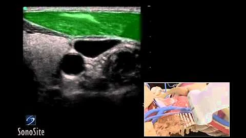 How To: Ultrasound Guided Insertion Internal Jugular Catheter (Trans) - Sonosite Ultrasound 3D Video