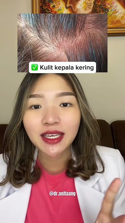 CARA MUDAH MENGHILANGKAN KETOMBE DI KEPALA! #ketombe #ketombetebal #aestheticdoctor #tipsrambut