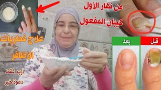 ادهنيها لأظافرك كل يوم وتخلصي تماما ونهائيا من فطريات الاظافر مجربة وفعالة 100%