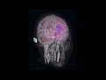 Butterfly Network’s Embedded™ Partner Aleph Neuro Unveils Stunning Brain Images