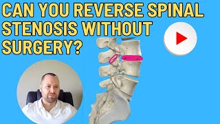 Can you reverse spinal stenosis without surgery?