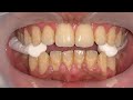 SCALING KARANG GIGI | Dentist | Dokter Gigi Tri Putra