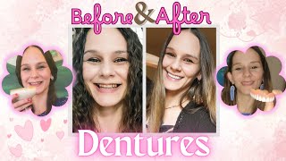 Before & After Dentures