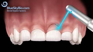 Clearwater Periodontist Shares What is a Gingivectomy by Blue Sky Bio
