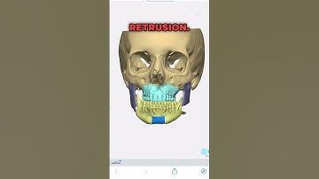 How to correct an asymmetric face through orthognathic surgery.