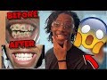 I Finally Got My Braces REMOVED!!! **LIFE CHANGING**