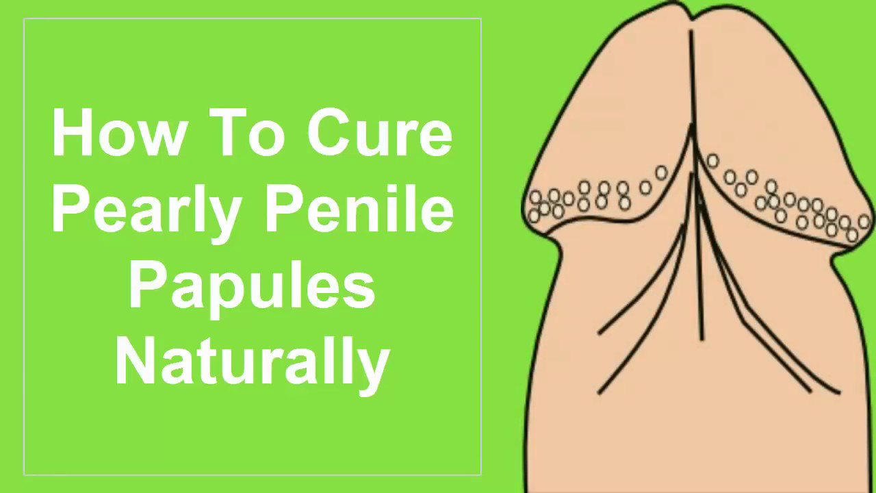 Pearly penile papules natural treatment