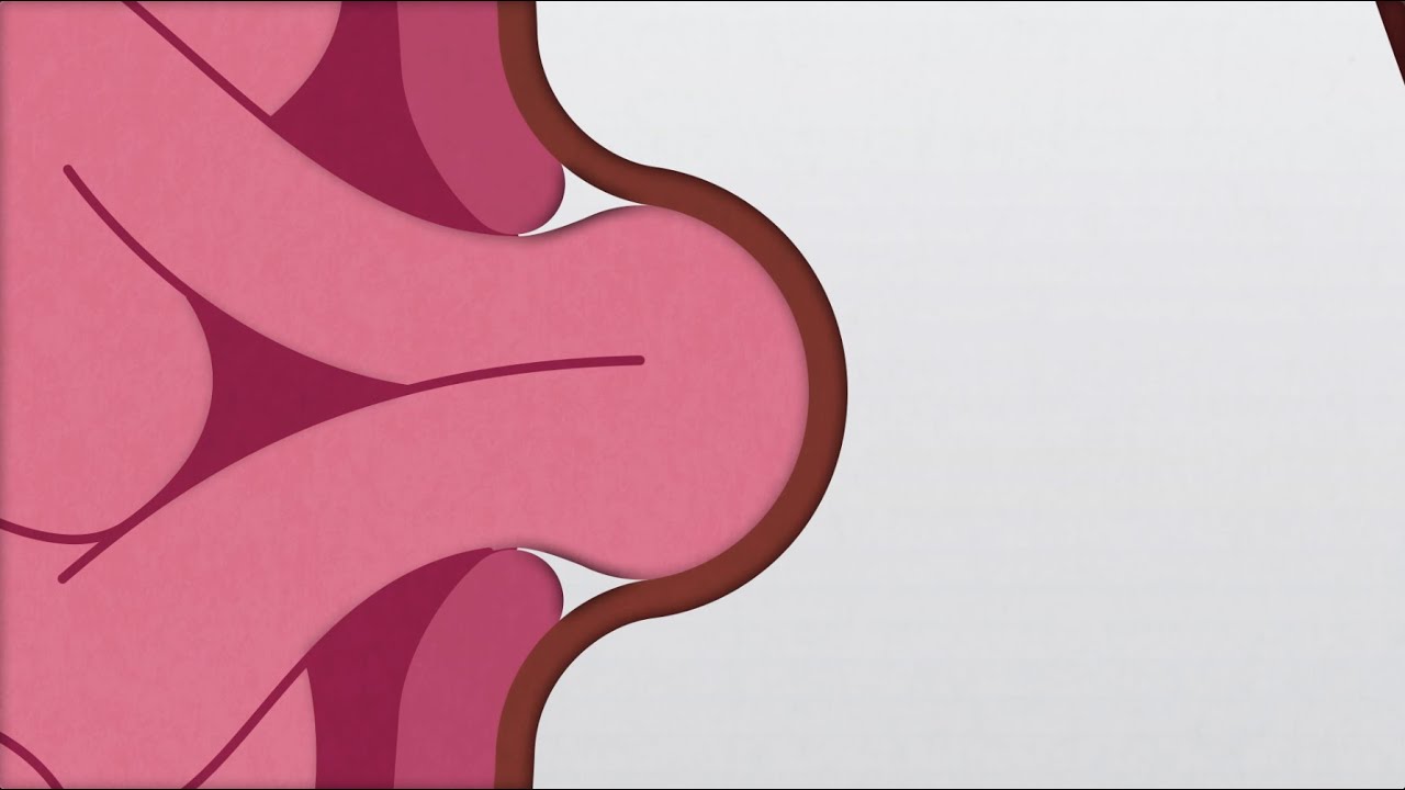 How Serious Is Bladder Hernia?