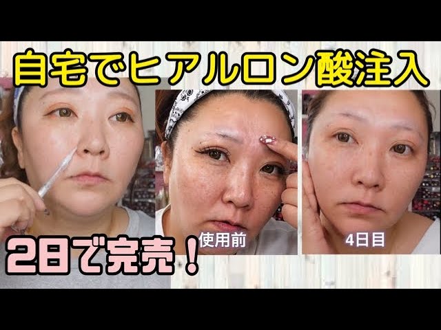 2日で完売】自宅でヒアルロン酸注入☆楽天デイリーランキング1位の  