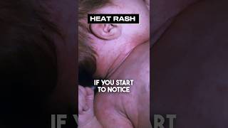 HEAT RASH in Kids: WHAT YOU NEED TO AVOID (Best Remedies)