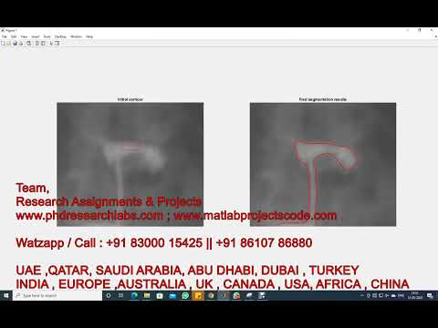 Active Contour Model Integrating Global and Local Information | Matlab code | Active Contour model