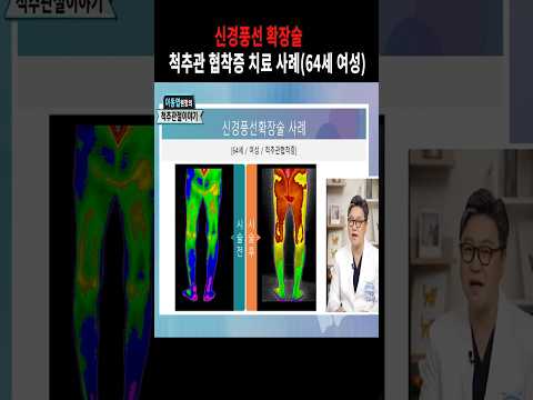 이동엽원장의 신경풍선확장술로 척추관 협착증 치료사례(64세 여성)