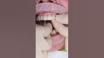 Dental implant’s All on 4 in Prague #shorts #dentist #dental #implant #veneers #short