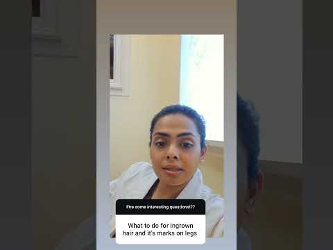 Kurious Minds: Dr. Karishma Responds | What to do with Ingrown Hair and its marks on Legs?