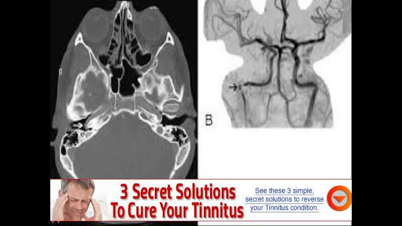 what causes pressure and ringing in the ears YouTube
