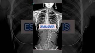 Escoliosis