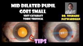 102 mid dilated pupil that goes smaller, soft cataract, toric trifocal- tips Dr Sourabh Patwardhan