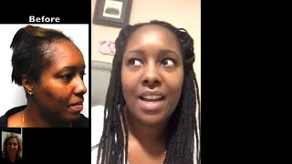 Fort Lauderdale Natural Transplants | Hair Transplant for Traction Alopecia in Fort Lauderdale