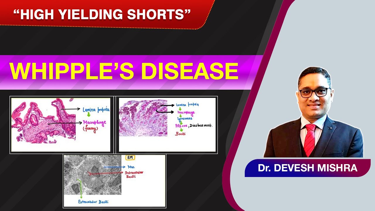 High Yielding Shorts-111 (#HYS-111):Niemann-Pick Disease Dr Devesh