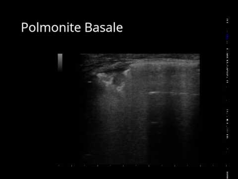 Polmonite Basale in ecografia toracica camera iphone 8 plus apk
