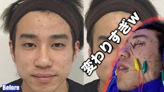 顔に針を刺しまくったら顔が変わりましたwww