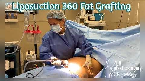 Liposuction 360 #plasticsurgery #liposuction #360lipo