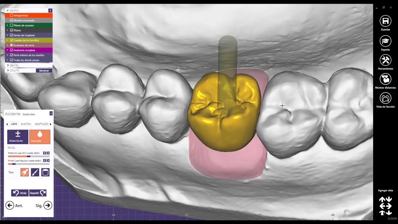 Exocad Digital Workflow with Hollow System