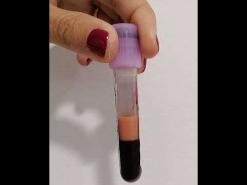 Lipemia en Hematología