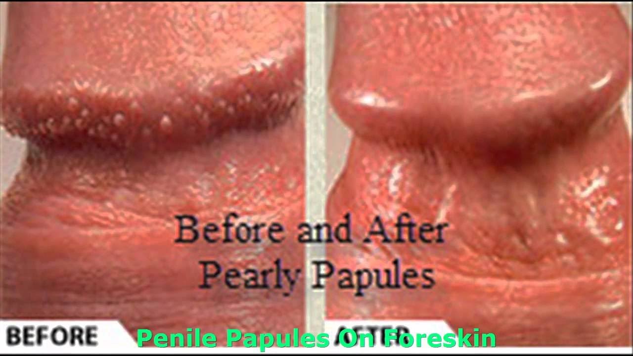Penile natural treatment papules pearly 3 Ways