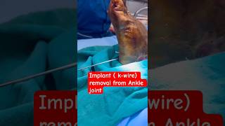 #bone #implant #fracture #orthopedics #viral #shortsfeed