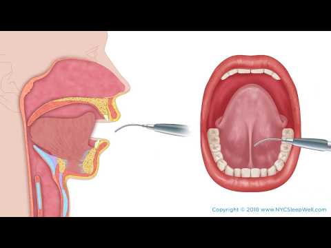 Video: Lingual Frenulum: Ebanormaalsete Seisundite Ravimine Ja Ennetamine