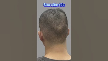 Sẹo do cấy tóc để lại, tôi đã phải đi xăm che sẹo tóc #xămtóc #hói #hói_đầu #scalp