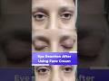 Eye Problem After Facial |Dr Kartik Gupta| Appointment- 8920090907